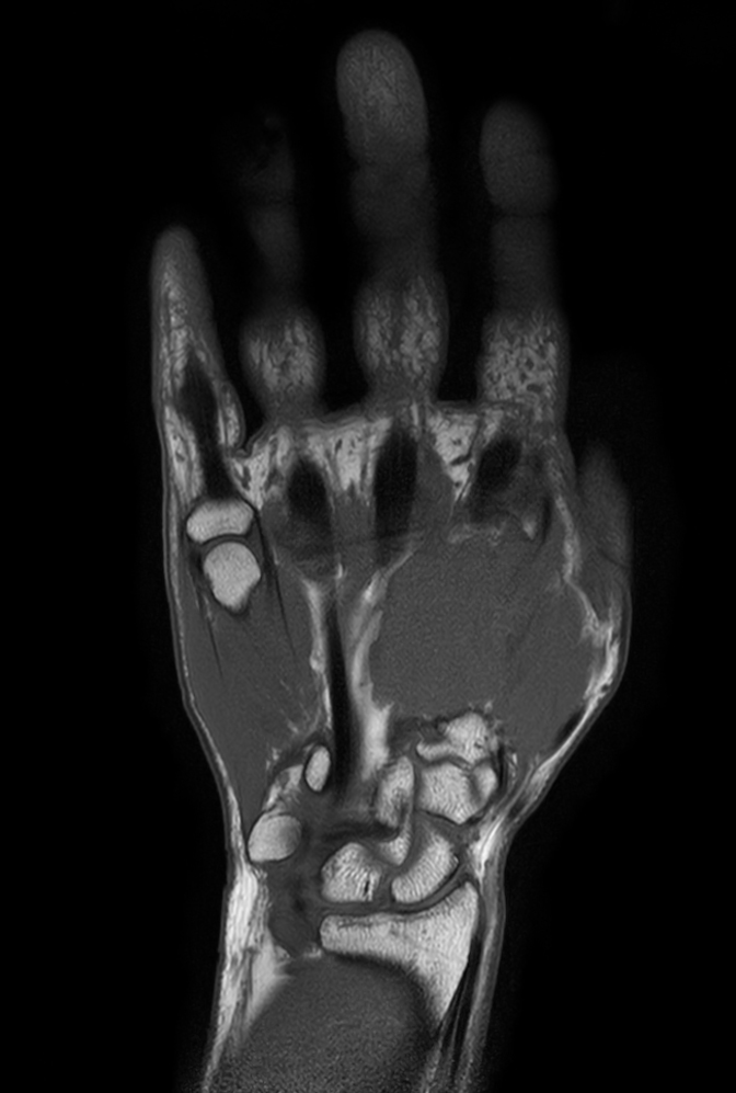 Coronal T1w TSE mDIXON XD (In Phase)