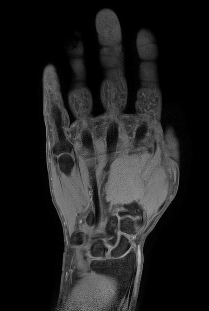 Coronal T1w TSE mDIXON XD (Water only)