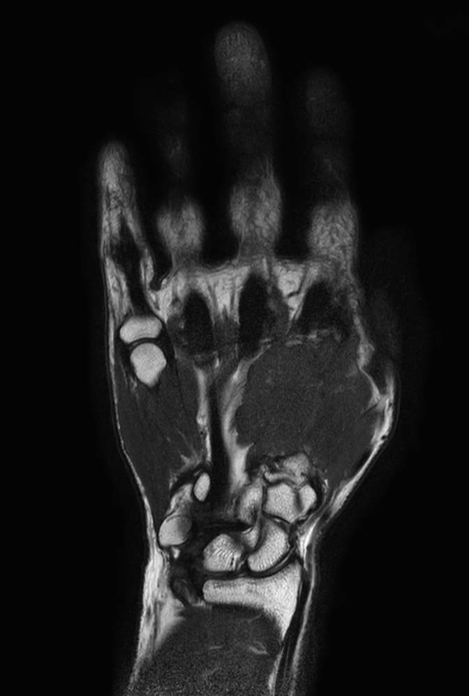 Coronal T2w TSE mDIXON XD (In Phase)