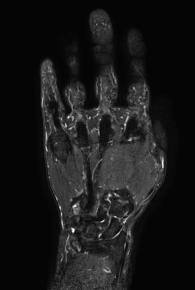 Coronal T2w TSE mDIXON XD (Water only)