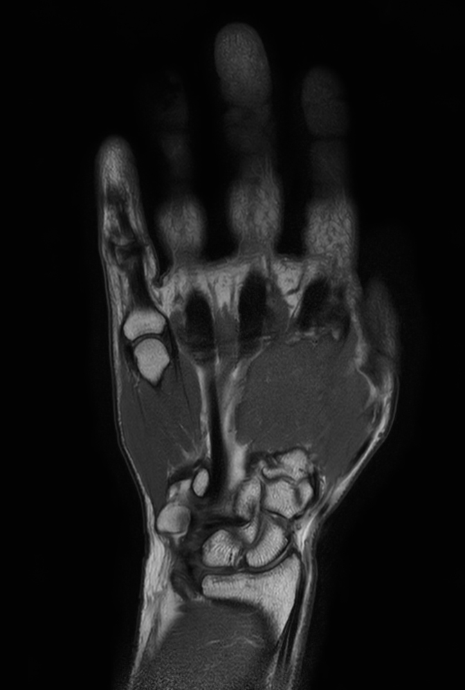 Coronal PDw TSE mDIXON XD (In Phase)