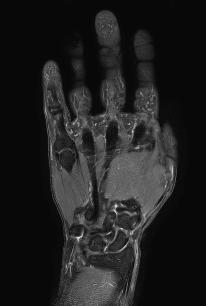 Coronal PDw TSE mDIXON XD (Water only)