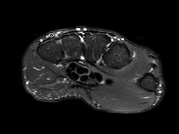 Axial STIR TSE