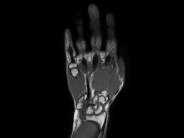 Coronal T1w TSE mDIXON XD (In Phase)