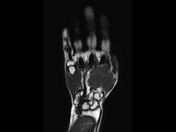 Coronal T2w TSE