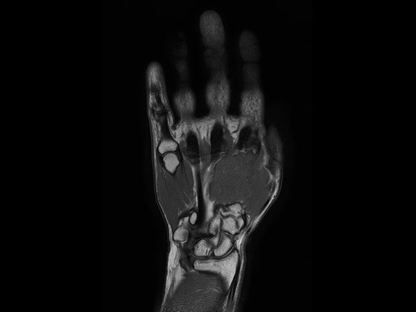 Coronal PDw TSE mDIXON XD (In Phase)