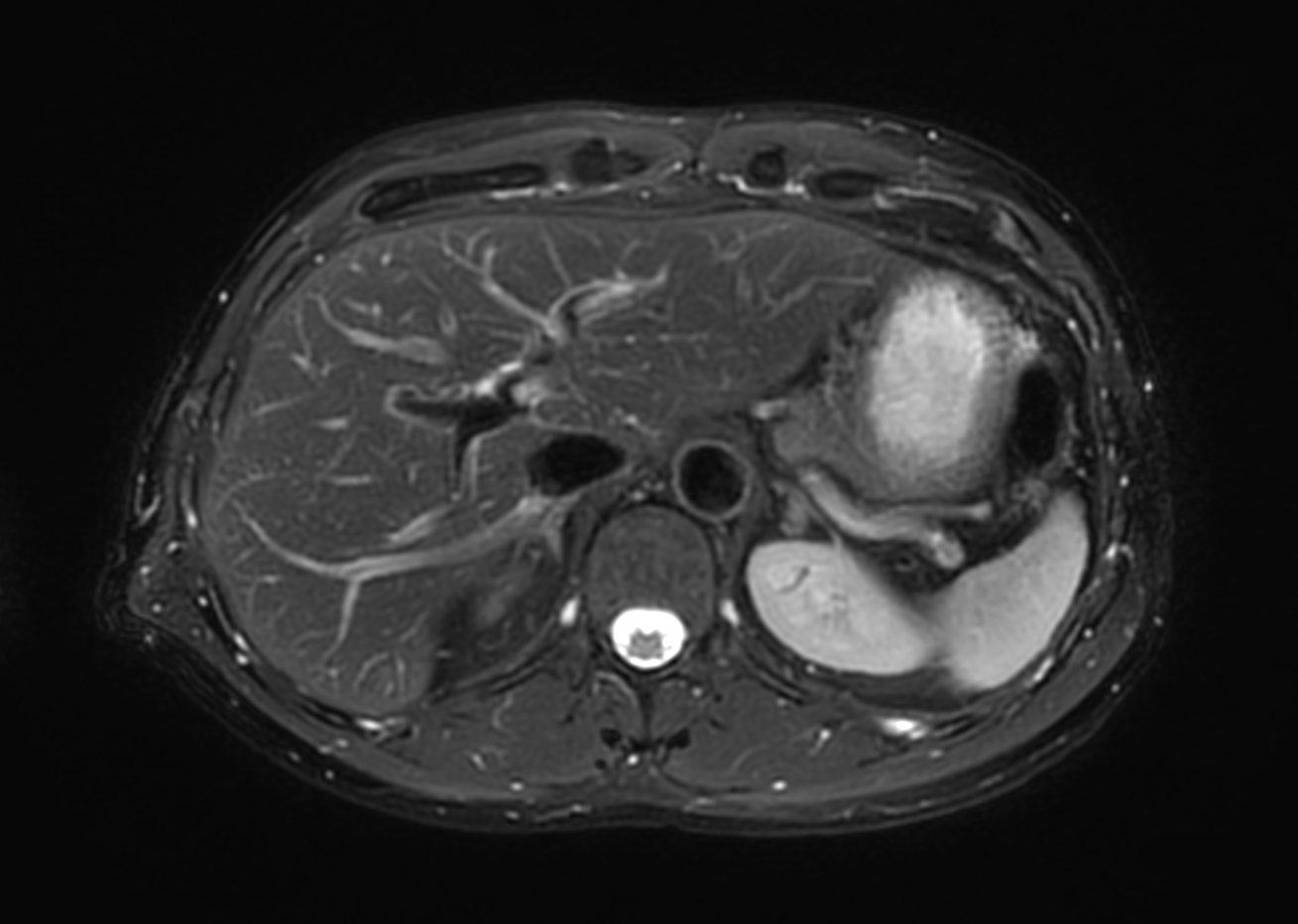 Axial T2w SPAIR MultiVane XD