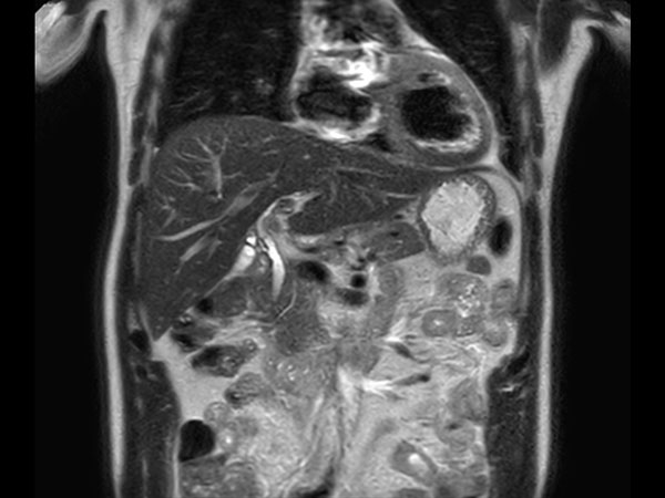 Coronal T2w TSE