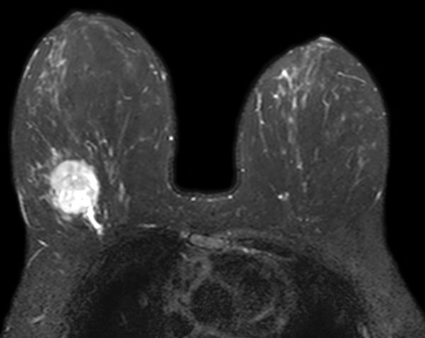 Axial T2w TSE with SPAIR