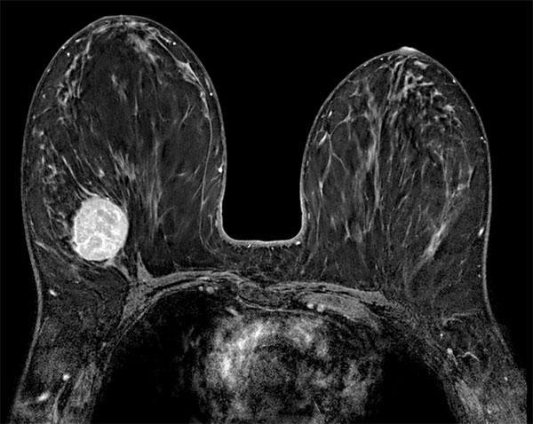 High resolution axial eTHRIVE