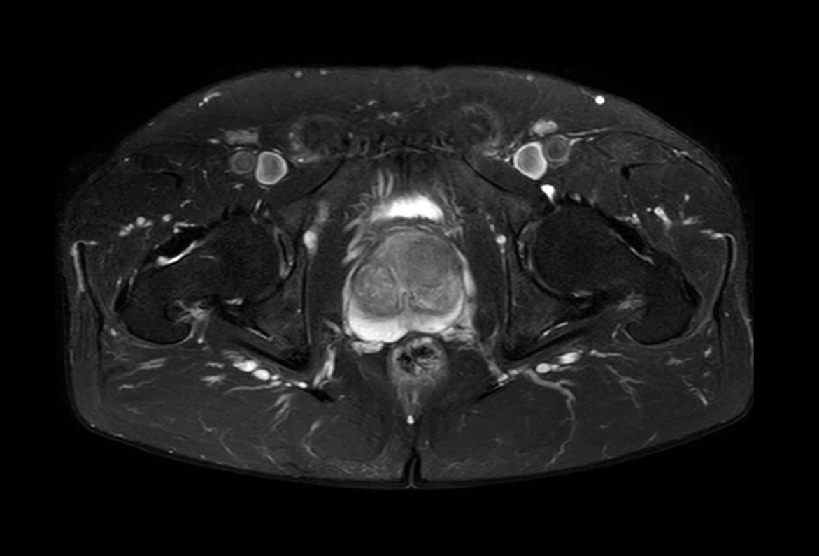 Axial T2w TSE FatSat