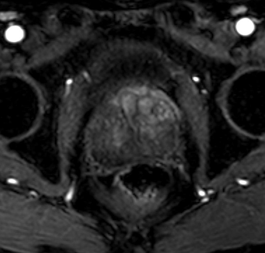 Axial dynamic T1w mDIXON XD - Permeability 48 sec