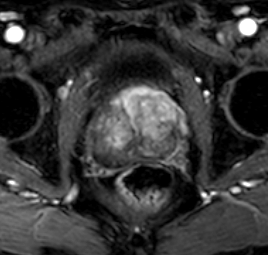 Axial dynamic T1w mDIXON XD - Permeability 1:08 min