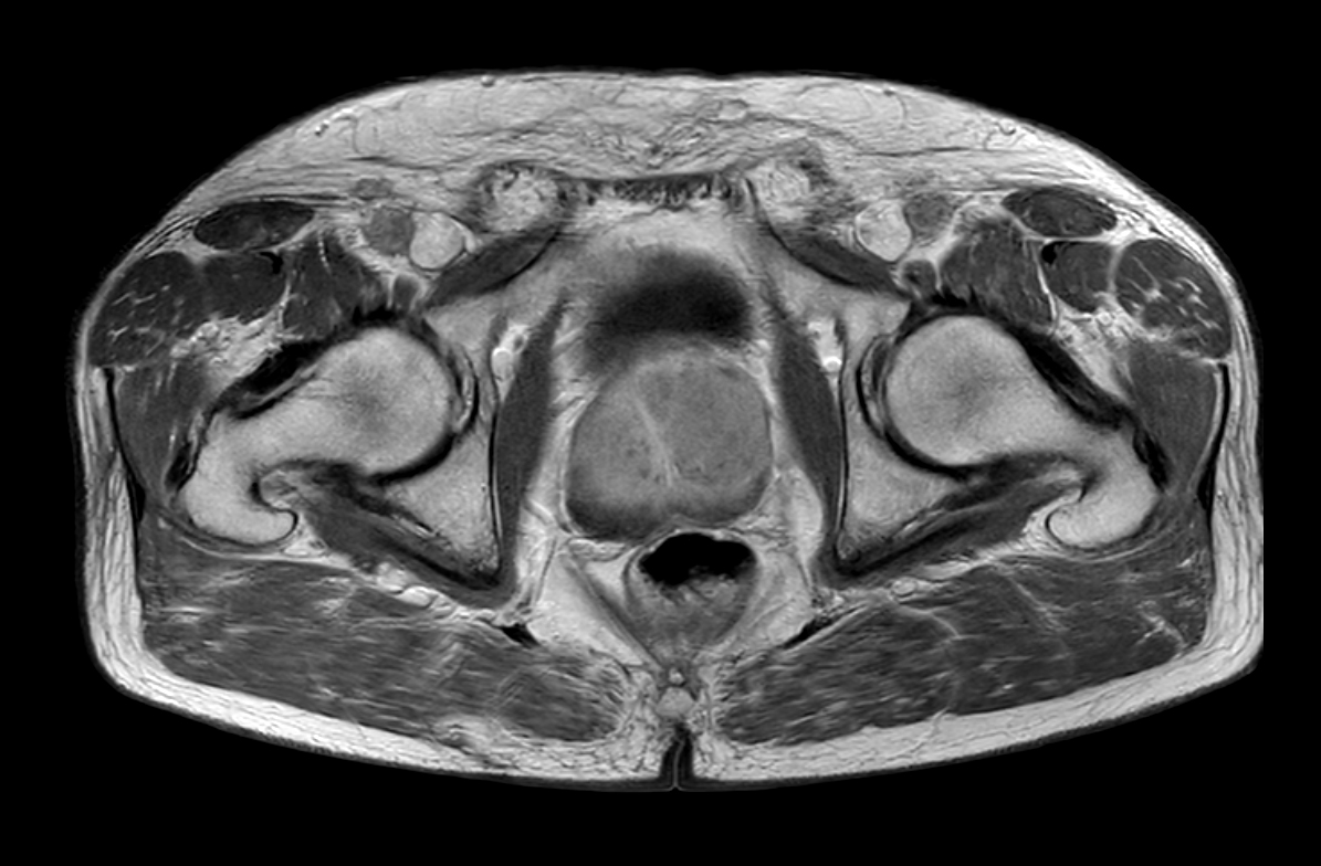 Axial T1w TSE (Pelvis) + gado