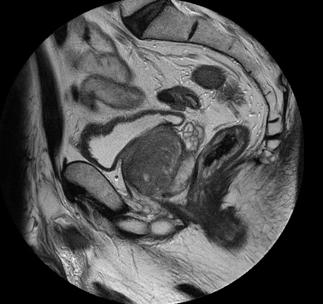 Sagittal T2w TSE - MultiVane XD