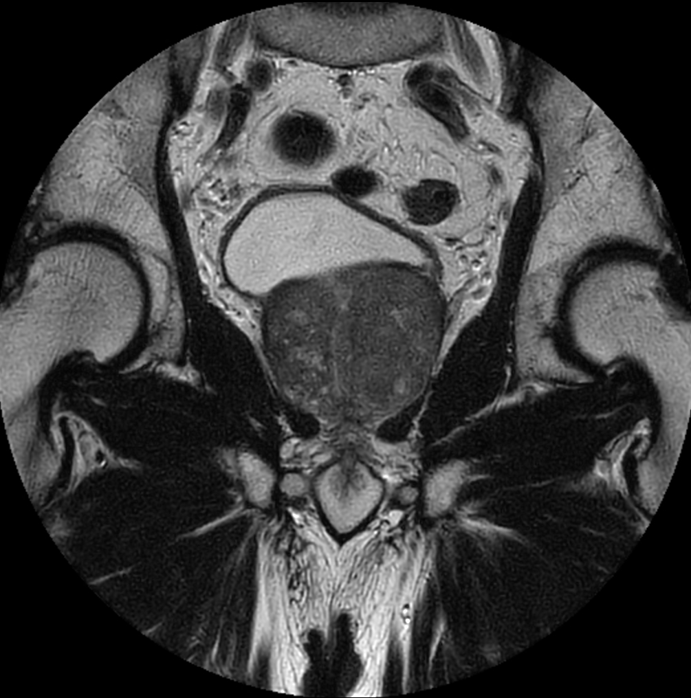 Coronal T2w TSE - MultiVane XD