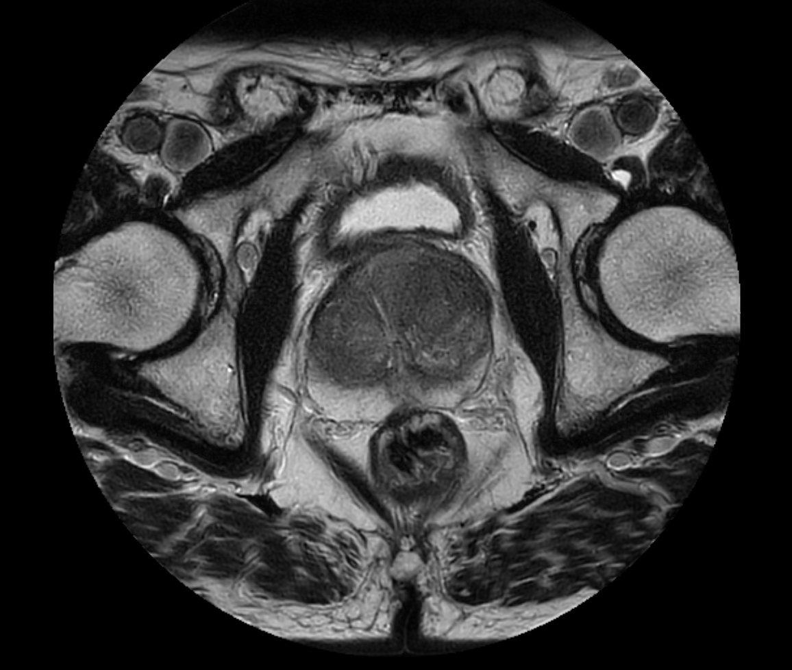 Axial T2w TSE - MultiVane XD