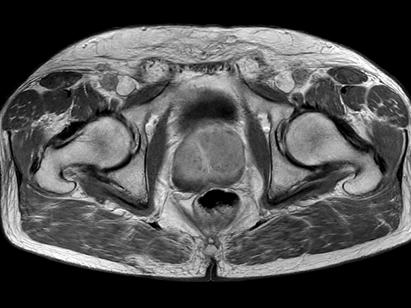 Axial T1w TSE (Pelvis) + gado