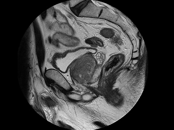 Sagittal T2w TSE - MultiVane XD