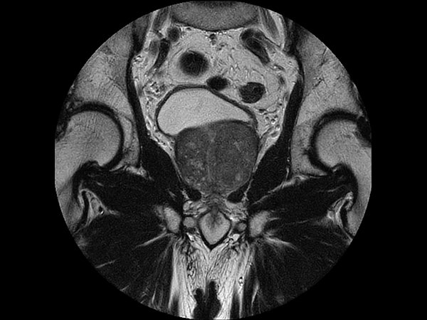 Coronal T2w TSE - MultiVane XD