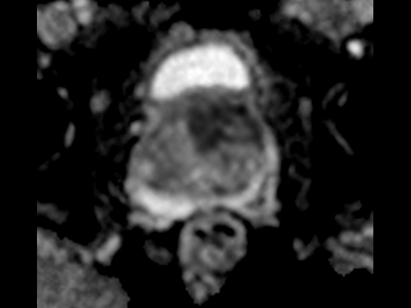 Axial DWI (ADC)