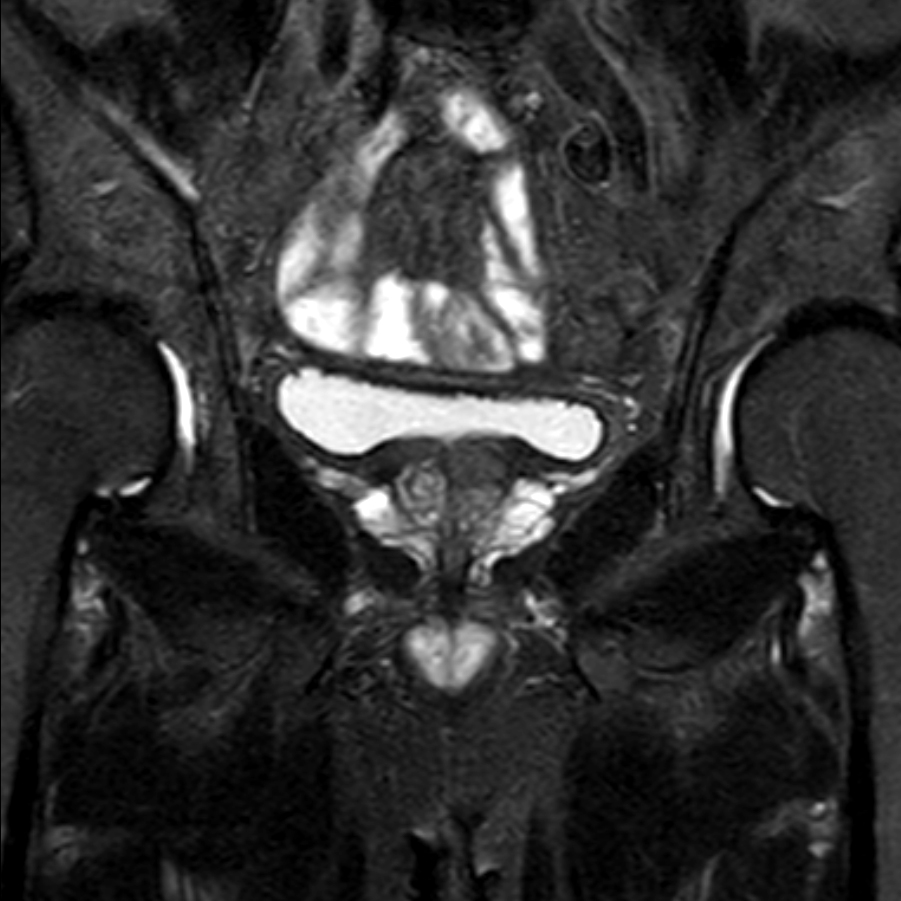 Coronal T2w TSE FatSat