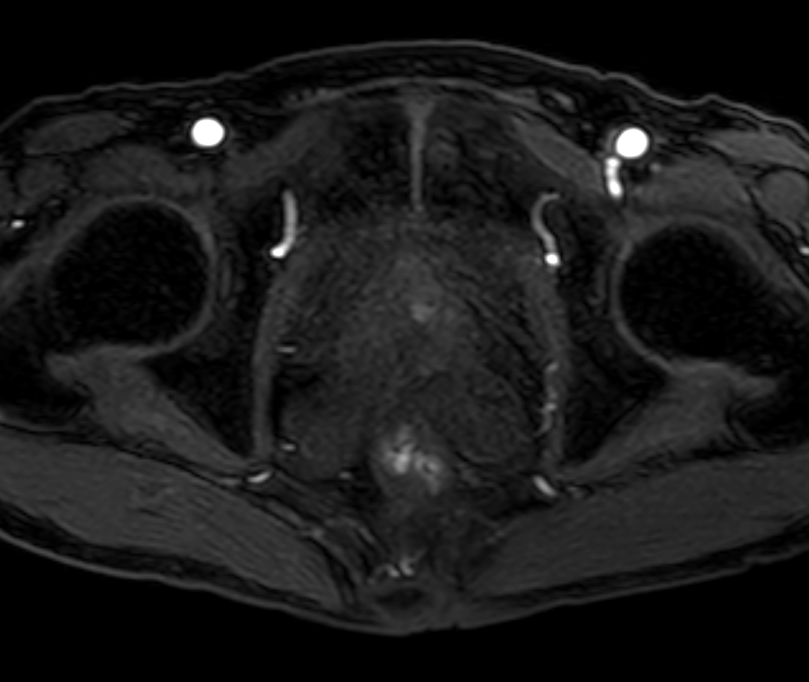 Axial dynamic T1w mDIXON XD - Permeability 1:04 min