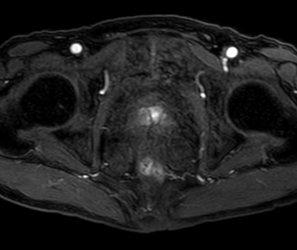 Axial dynamic T1w mDIXON XD - Permeability 1:27 min
