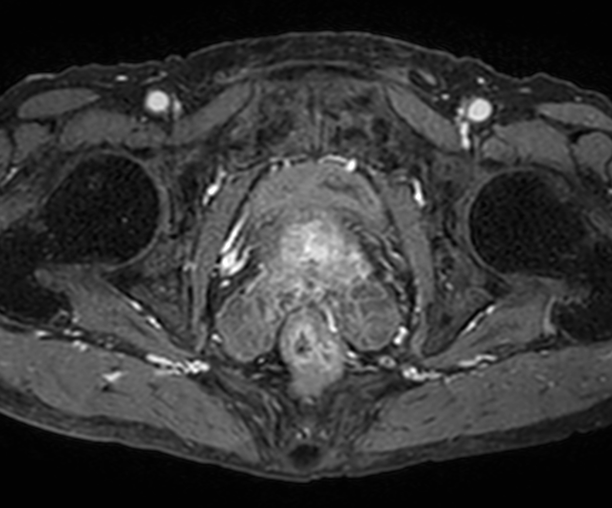 Axial eTHRIVE + gado