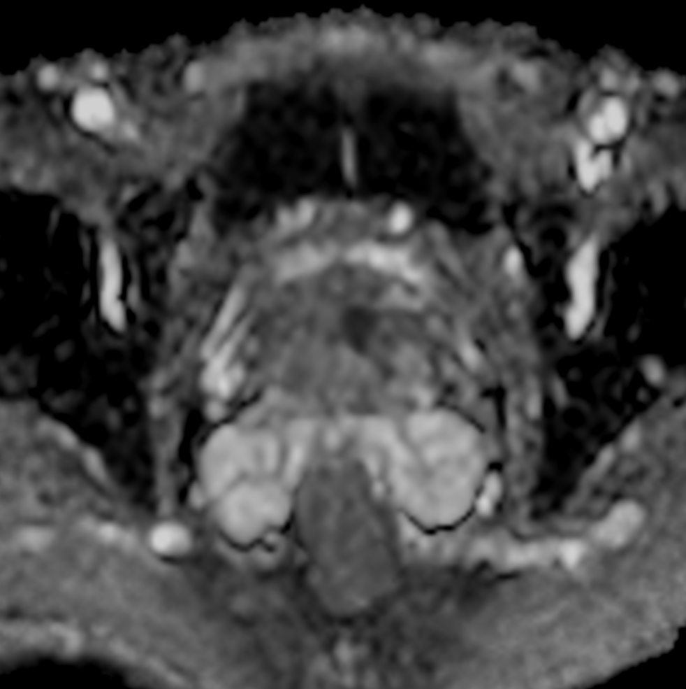 Axial DWI (b1000, ADC)