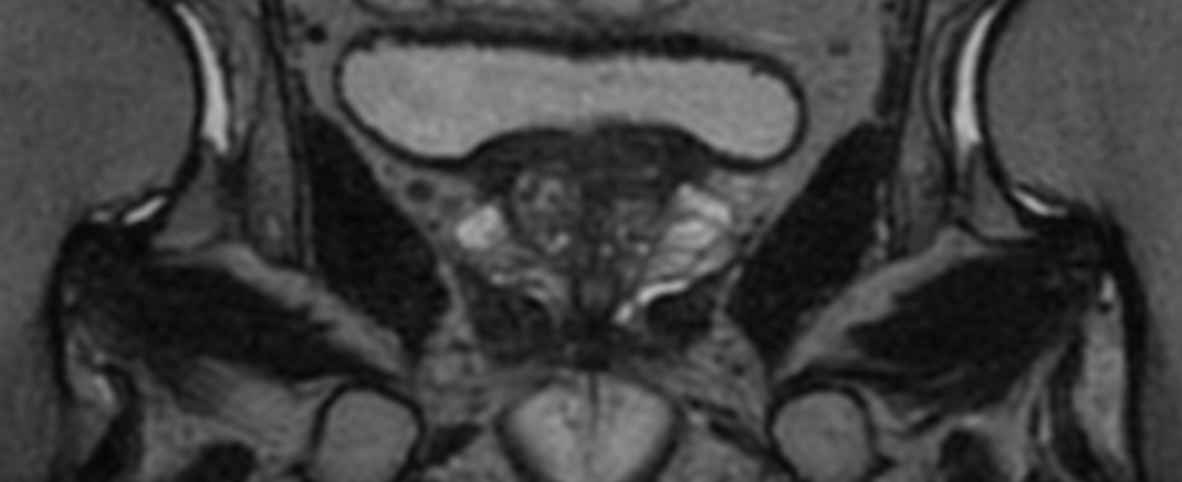 3D T2w TSE PelvisVIEW - Coronal reformat