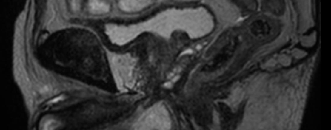 3D T2w TSE PelvisVIEW - Sagittal reformat