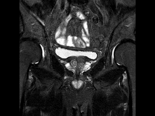 Coronal T2w TSE FatSat