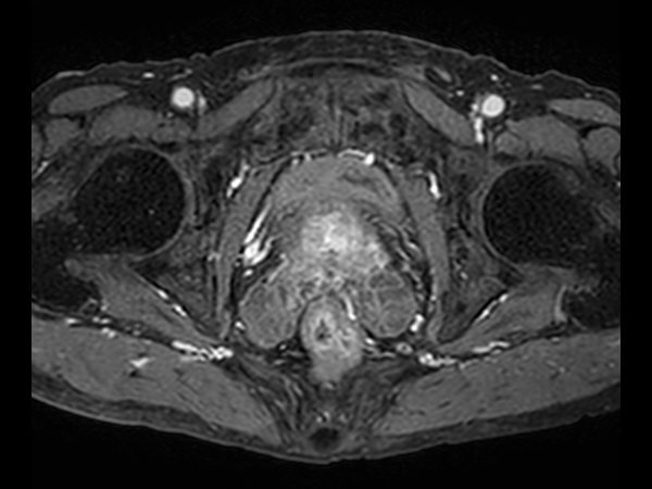 Axial eTHRIVE + gado