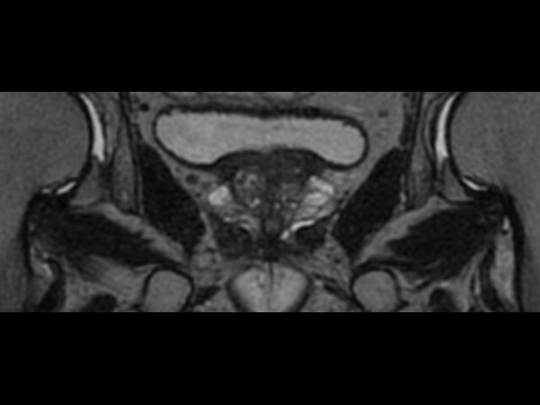 3D T2w TSE PelvisVIEW - Coronal reformat