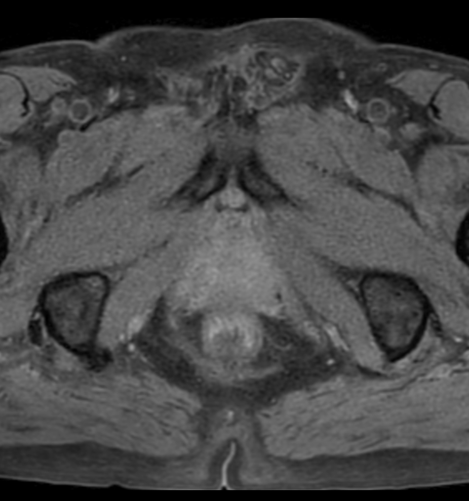 Axial T1w TSE mDIXON XD (Water only)