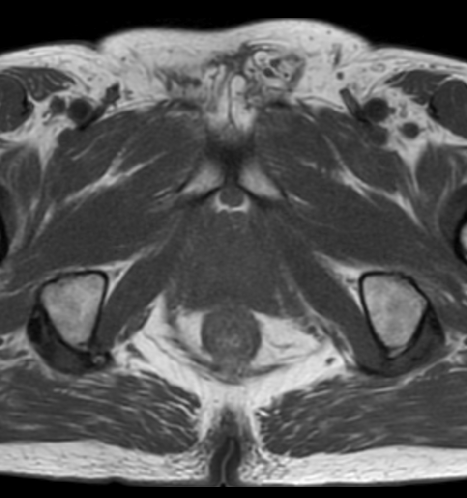 Axial T1w TSE mDIXON XD (In Phase)