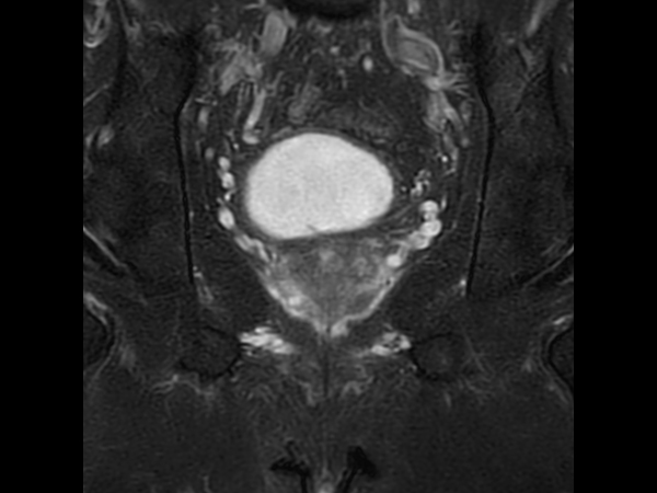 Coronal T2w SPAIR