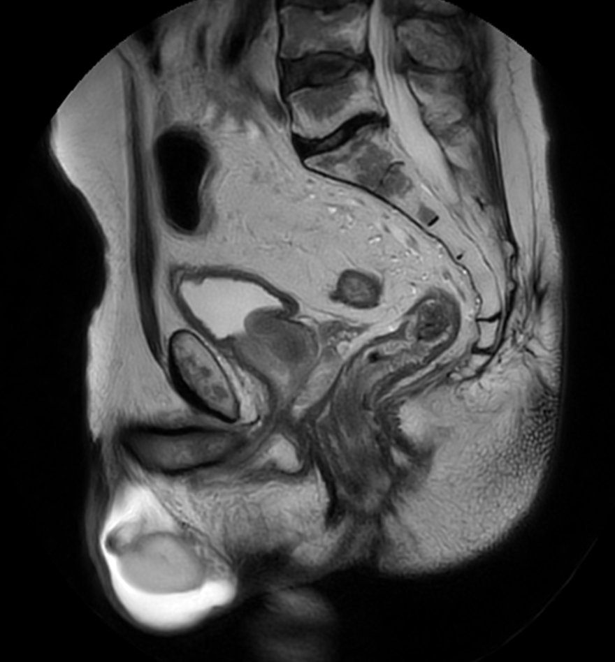 Sagittal T2w TSE MultiVane XD