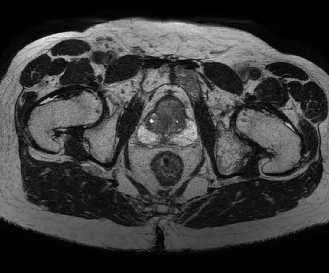 Axial 3D T2w TSE PelvisVIEW with Compressed SENSE