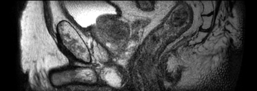 3D T2w TSE PelvisVIEW with Compressed SENSE - Sagittal reformat