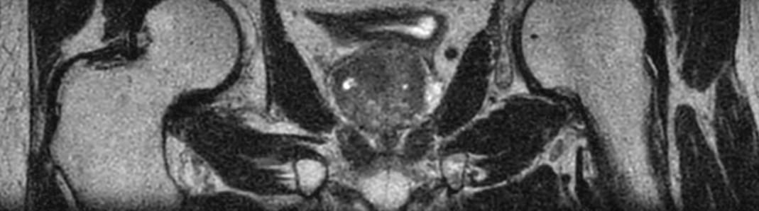 3D T2w TSE PelvisVIEW with Compressed SENSE - Coronal reformat