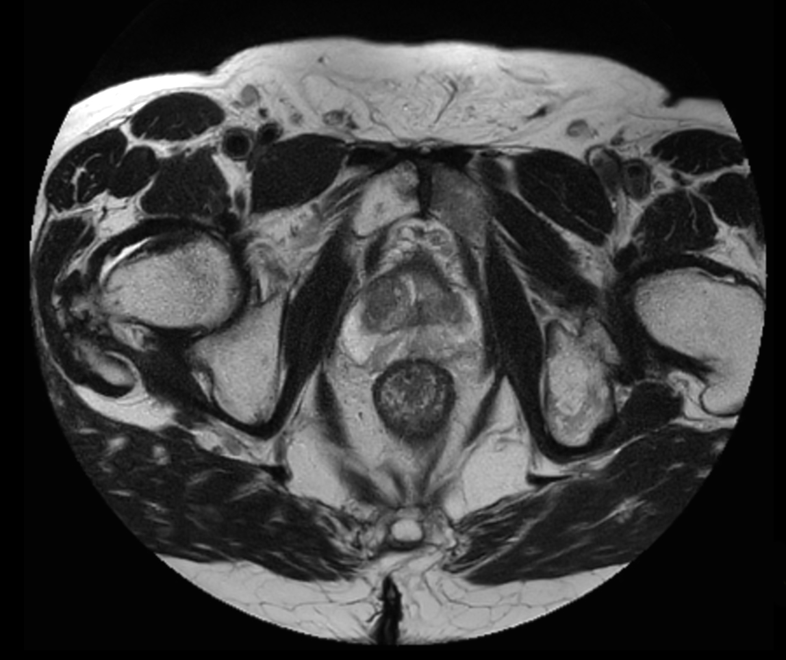 Axial T2w TSE MultiVane XD