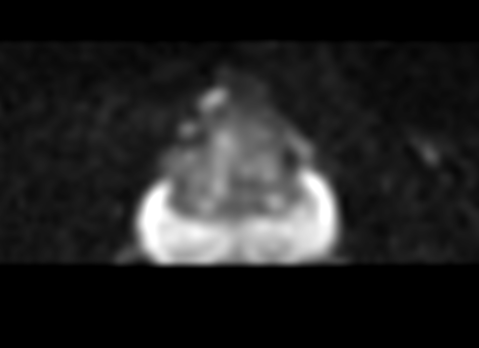 Axial Zoom Diffusion (b100)