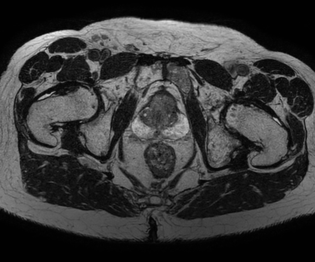 Axial 3D T2w TSE PelvisVIEW