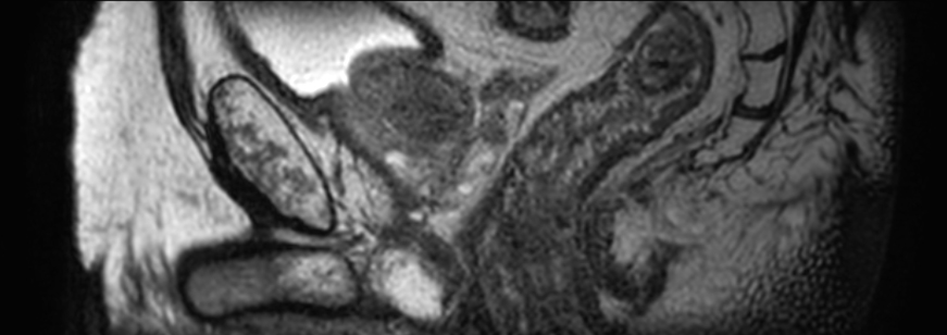 3D T2w TSE PelvisVIEW - Sagittal reformat