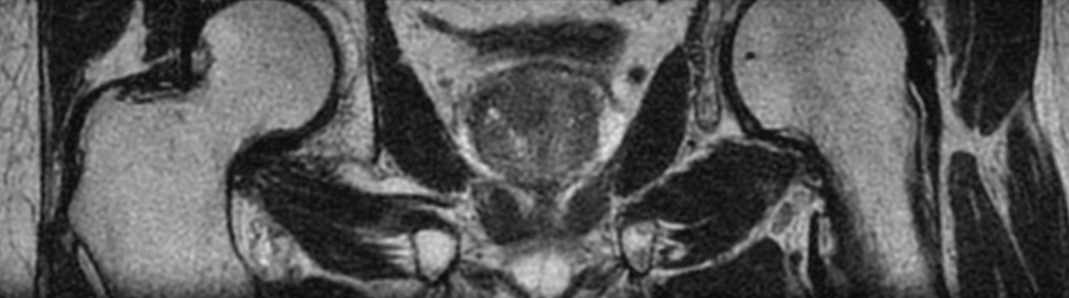 3D T2w TSE PelvisVIEW - Coronal reformat