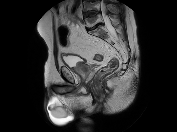 Sagittal T2w TSE MultiVane XD