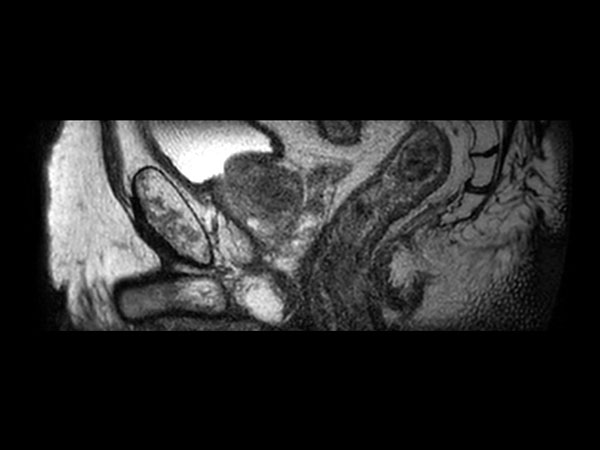 3D T2w TSE PelvisVIEW with Compressed SENSE - Sagittal reformat