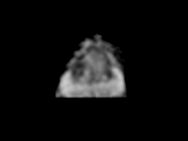 Axial Zoom Diffusion (ADC)